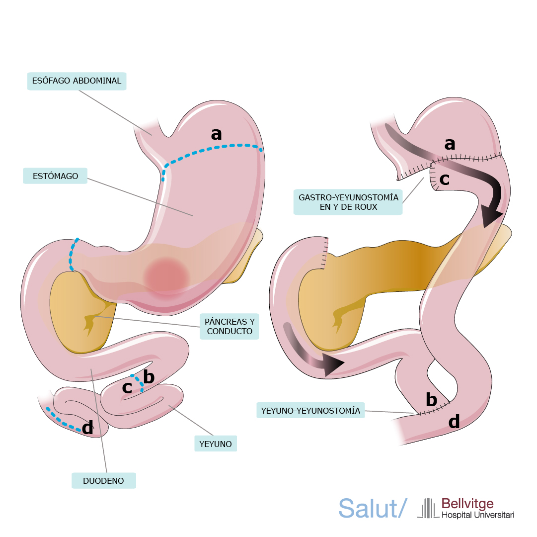 gastrectomia subtotal